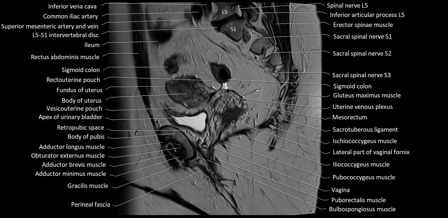 Sagittal cross sectional anatomy of female pelvis (MRI 3T) image 16.webp